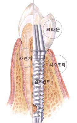 임플란트 시술기간 2개월 단축 화제