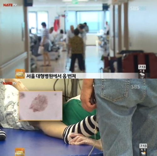 대학병원 옴 확산…일주일 새 20명 '병 고치려다 혹 붙여'