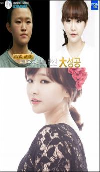 '1초 박은지' 윤아름 근황, '수술 전후 얼굴보니 성형모델 할 만'