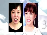 '렛미인3' 치아부식녀, 김아중 닮은꼴 충격 변신…"역대 레전드급"