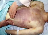 28사단 윤 일병 사망 사건 일파만파...군 인권센터 "살해 의도성 명백하다" 주장  