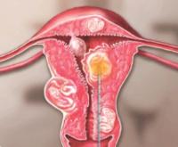  심한 생리통으로 고생하는여성, 자궁근종 의심해야