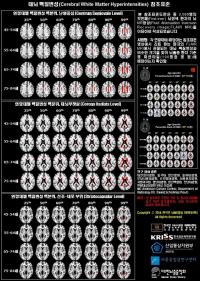 '허혈뇌지도'로 뇌경색 예측한다