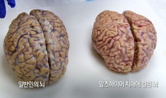 사진=KBS 생로병사의 비밀