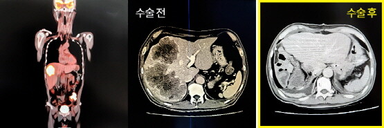 간전이 된 4기대장암환자 수술 전후 모습. 사진=온종합병원 제공