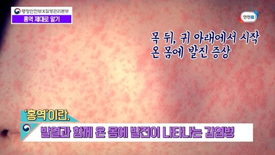 홍역은 급성 발진성 바이러스 질환으로 전염성이 매우 높다. 홍역에 걸리면 초기에 감기처럼 기침, 콧물, 결막염 등의 증상이 나타나고, 고열과 함께 얼굴에서 시작해서 온몸에 발진이 나타난다. 사진=국민안전방송 안전한TV 영상 캡처