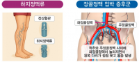 온병원 “하지정맥류·장골정맥압박증후군 모두 종아리 붓고 통증 심해”